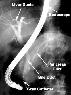 Endoscopic Retrograde Cholangio-pancreatography Endoscopic Retrograde Cholangio-pancreatography