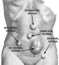 Locations of several types of hernia Locations of several types of hernia