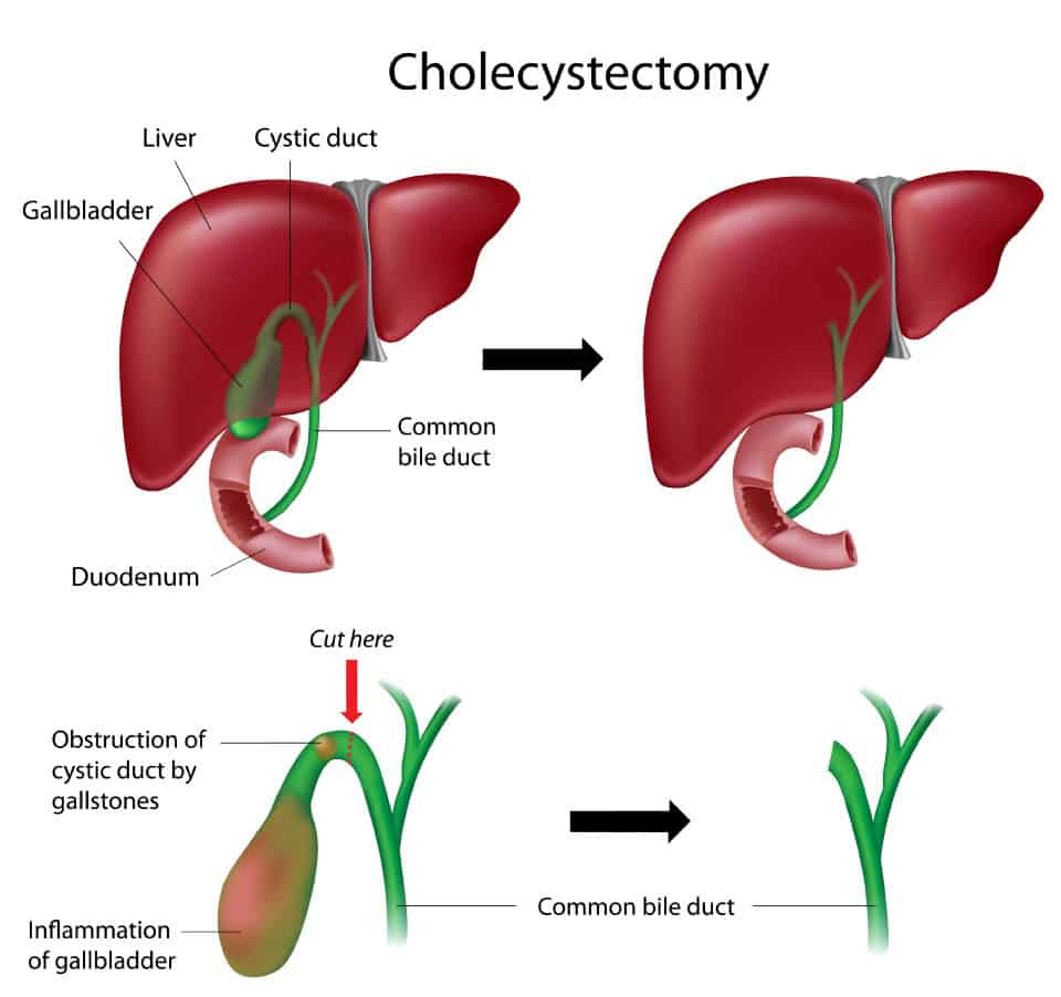 Cholecystectomy Surgery Illustration of Cholecystectomy Surgery