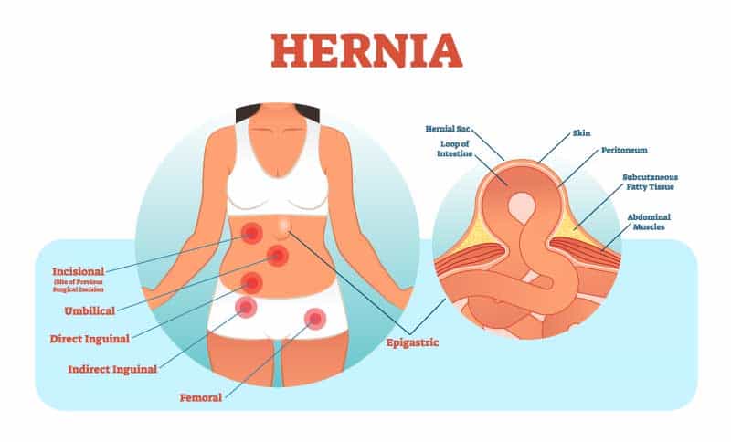 Hernia illustration Hernia illustration