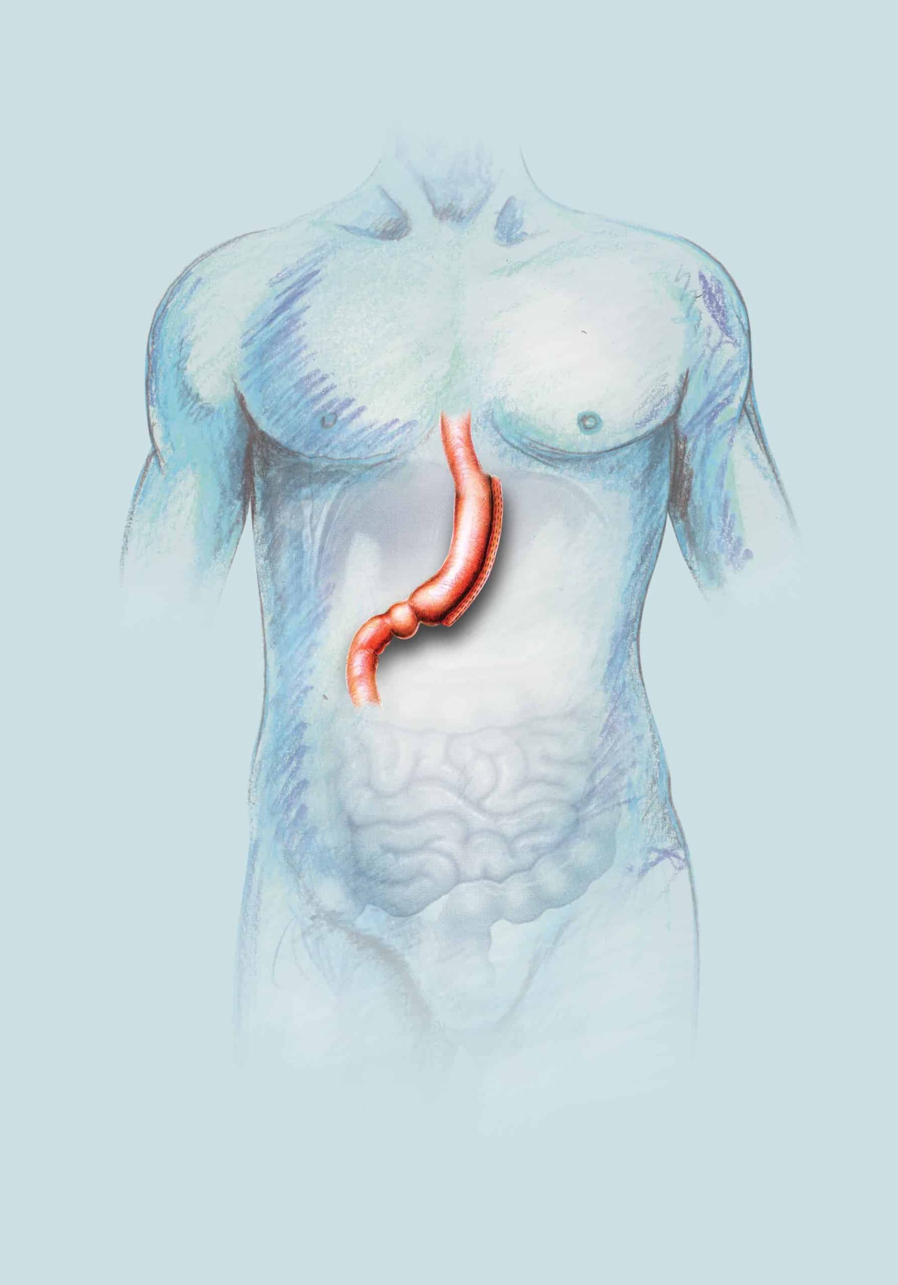 sleeve Gastric sleeve